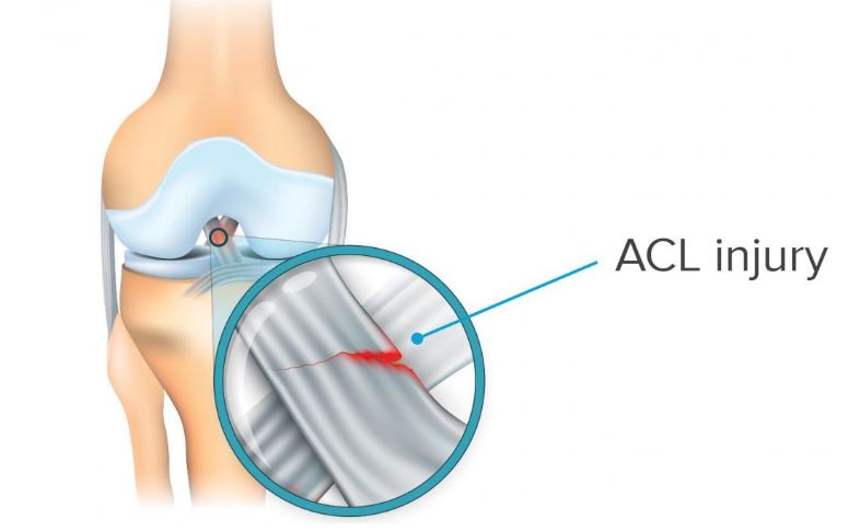 Minh họa chấn thương ACL chan thuong day chang cheo